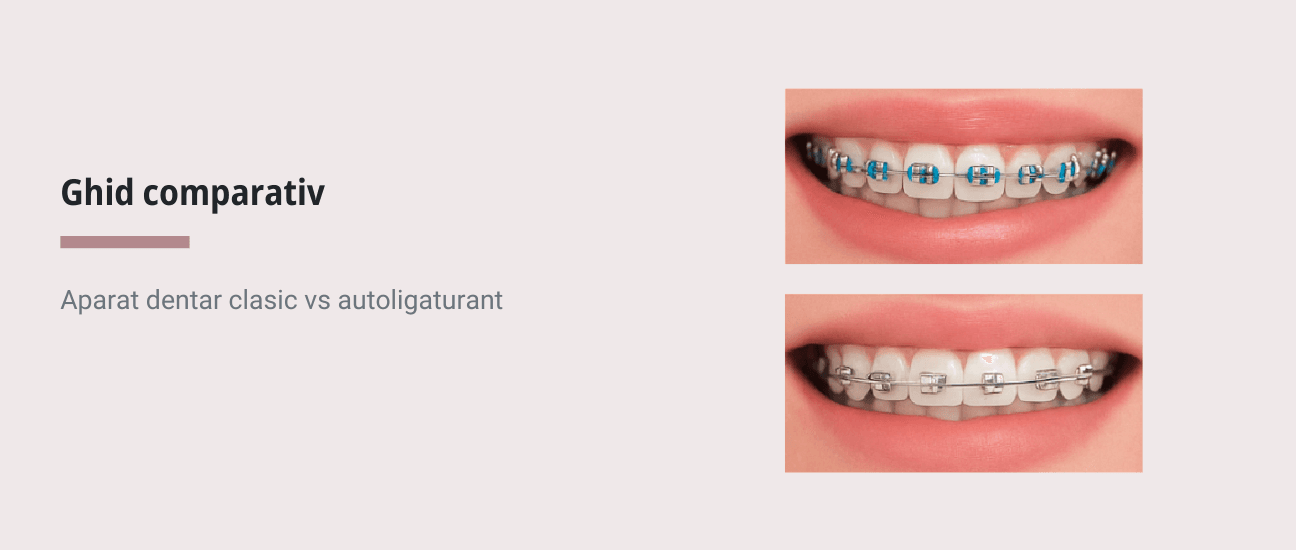 Comparatie Aparat dentar clasic vs. aparat dentar autoligaturant - Articol ortodonție Cluj