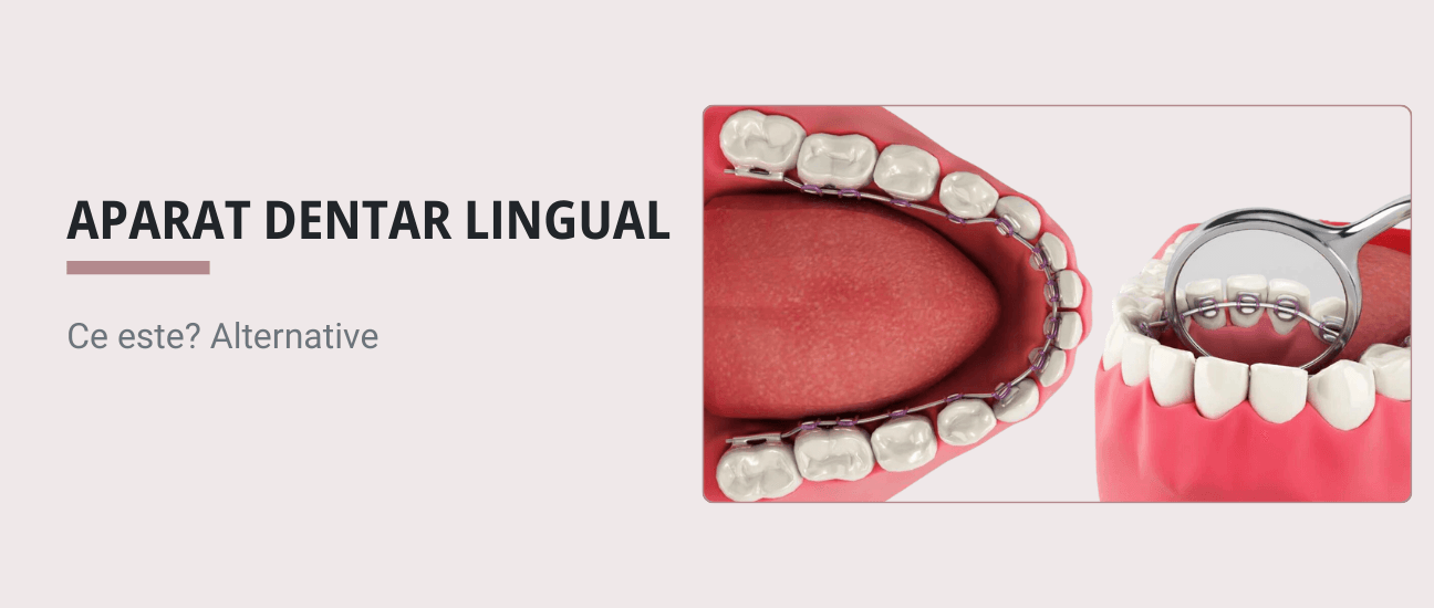 Ce este un aparat dentar lingual? - Articol ortodonție Cluj