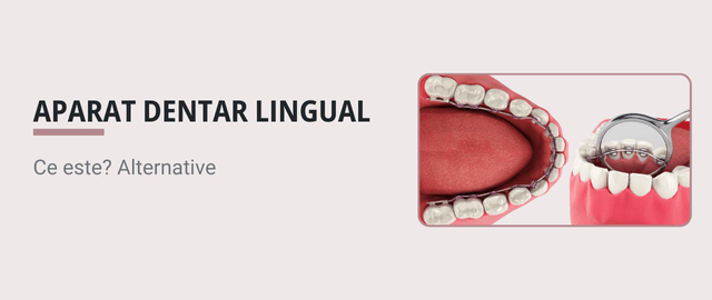 Ce este un aparat dentar lingual? - Articol ortodonție Cluj