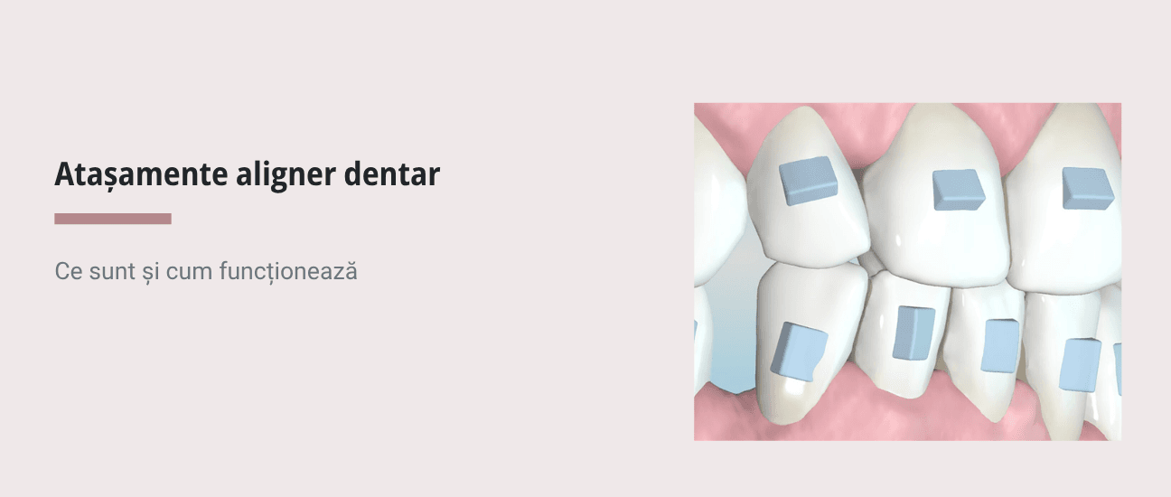 Atașamente pentru alignere dentare: ce sunt și cum funcționează la Spark - Articol stomatologie