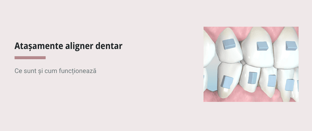 Atașamente pentru alignere dentare (Spark) - Articol stomatologie