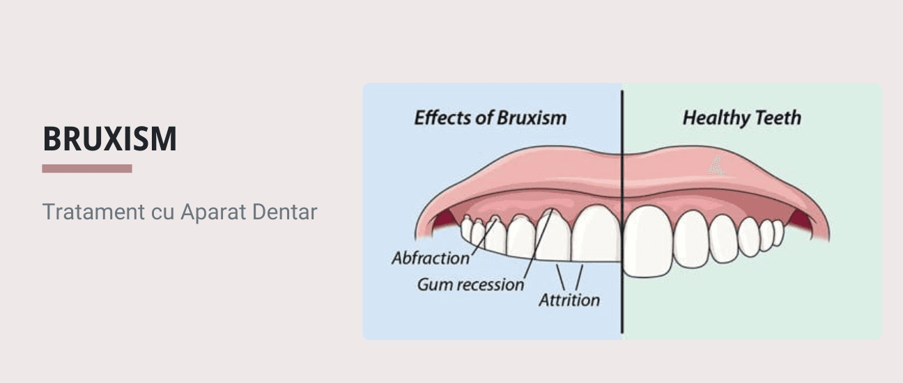 Ce este Bruxismul si cum se poate trata cu Aparat Dentar - Articol ortodonție Cluj