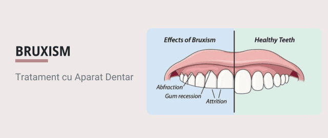 Ce este Bruxismul si cum se poate trata cu Aparat Dentar - Articol ortodonție Cluj