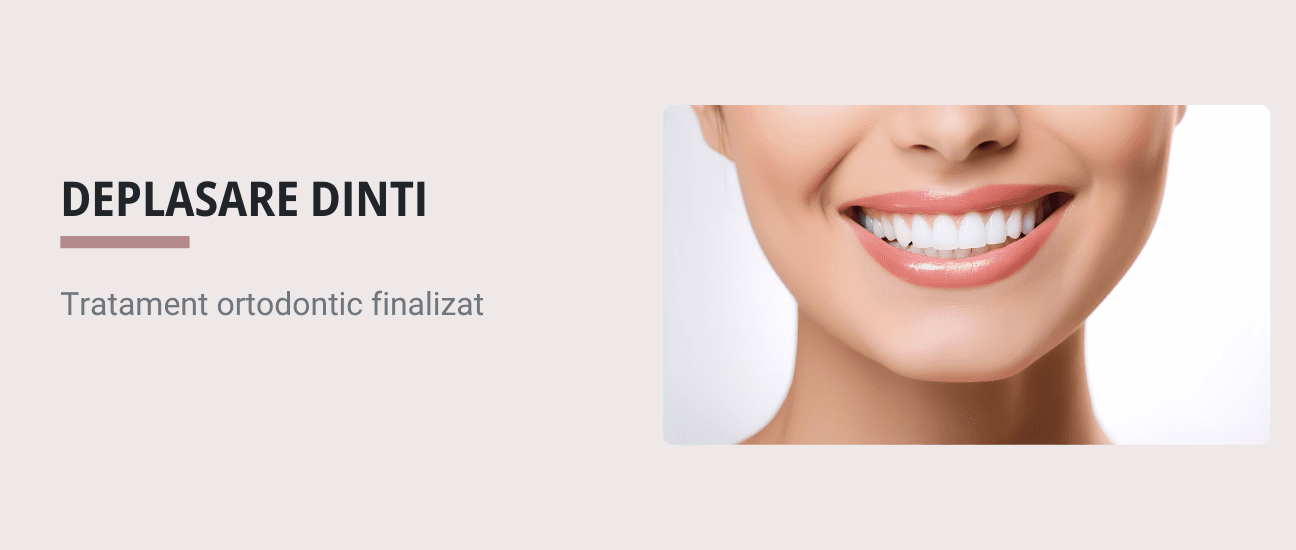Ce cauzeaza deplasarea dintilor dupa tratamentul ortodontic (aparat dentar)? - Articol ortodonție Cluj