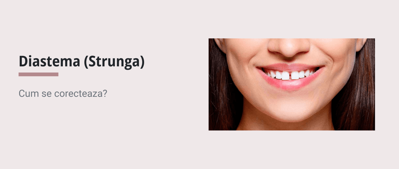 Corectare Diastema (Strunga) cu aligner dentar Spark - Articol ortodonție Cluj