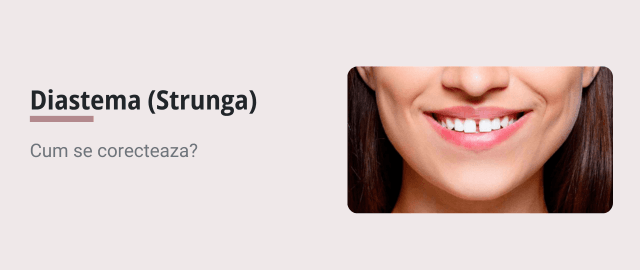 Corectare Diastema (Strunga) cu aligner dentar Spark - Articol ortodonție Cluj