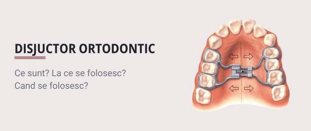 Disjunctor Ortodontic: Ce sunt? La ce se folosesc? Cand se folosesc? - Articol ortodonție Cluj