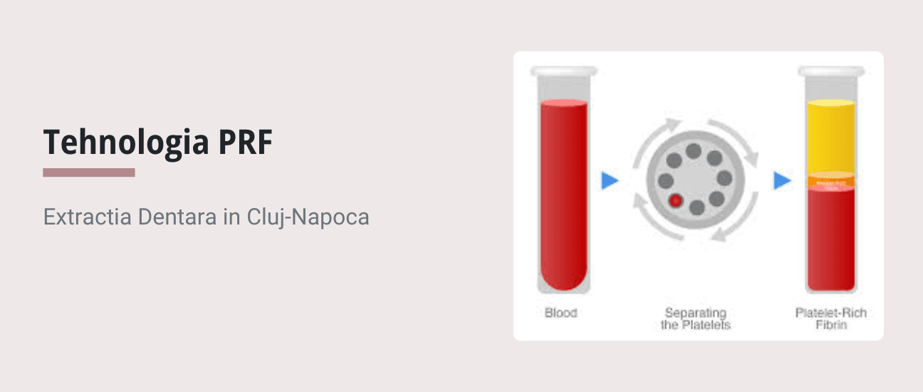 Tehnologia PRF si extractia dentara in Cluj-Napoca - Articol ortodonție Cluj