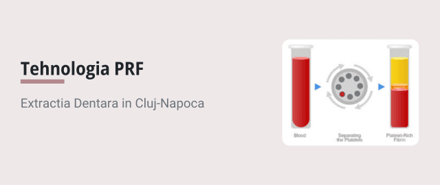 Tehnologia PRF si extractia dentara in Cluj-Napoca - Articol ortodonție Cluj