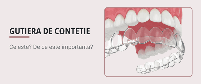 Ce este o contentie dentara si la ce se foloseste gutiera de contentie? - Articol ortodonție Cluj
