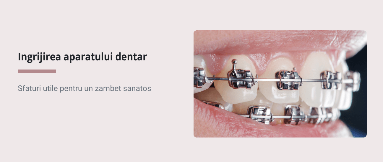 Ingrijirea aparatului dentar - Articol ortodonție Cluj