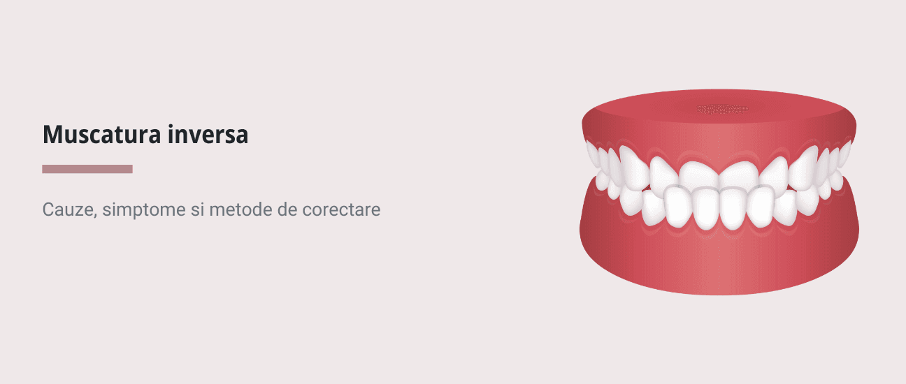 Muscatura inversa: cauze, simptome si metode de corectare - Articol stomatologie