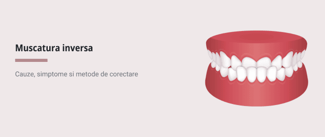 Muscatura inversa: cauze, simptome si metode de corectare - Articol stomatologie