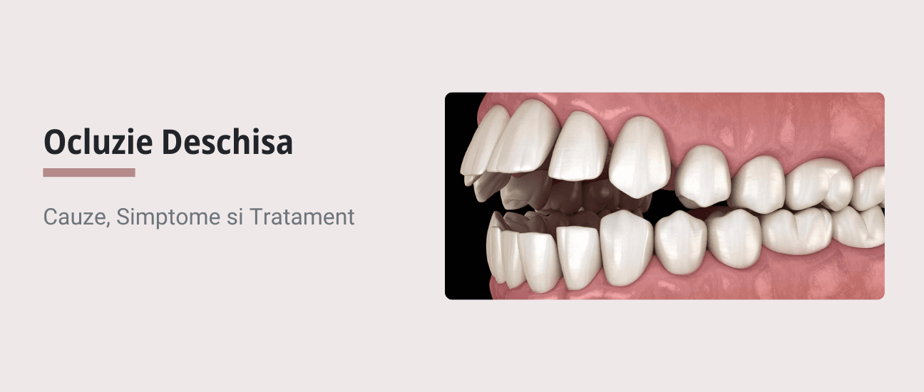 Ocluzie Deschisa: Ce Este, De Ce Apare si Cum Se Trateaza - Articol ortodonție Cluj