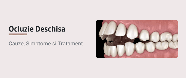 Ocluzie Deschisa: Ce Este, De Ce Apare si Cum Se Trateaza - Articol ortodonție Cluj