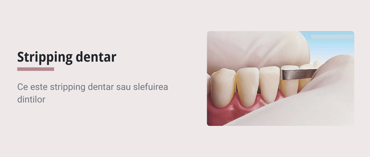 Stripping-ul dentar in ortodontie: ce este, la ce foloseste si cand este necesara slefuirea dintilor - Articol ortodonție Cluj