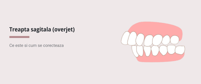 Treapta sagitala (overjet) - ce este si cum se corecteaza - Articol stomatologie