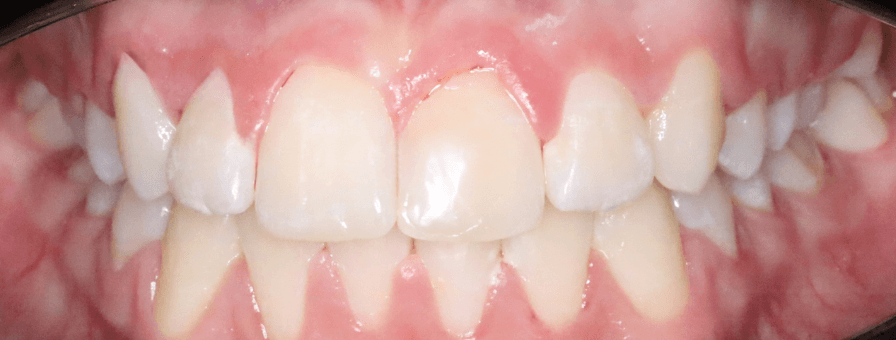 După tratamentul ortodontic