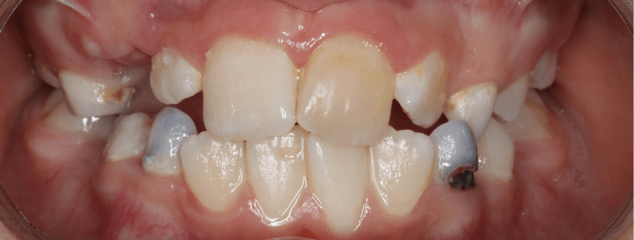 Înainte de tratamentul ortodontic