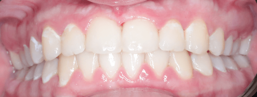 După tratamentul ortodontic