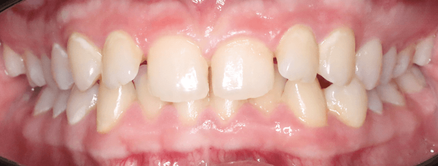 Înainte de tratamentul ortodontic