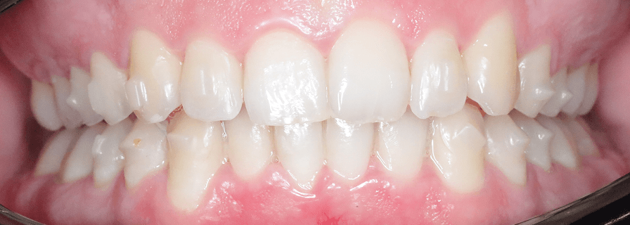 După tratamentul ortodontic