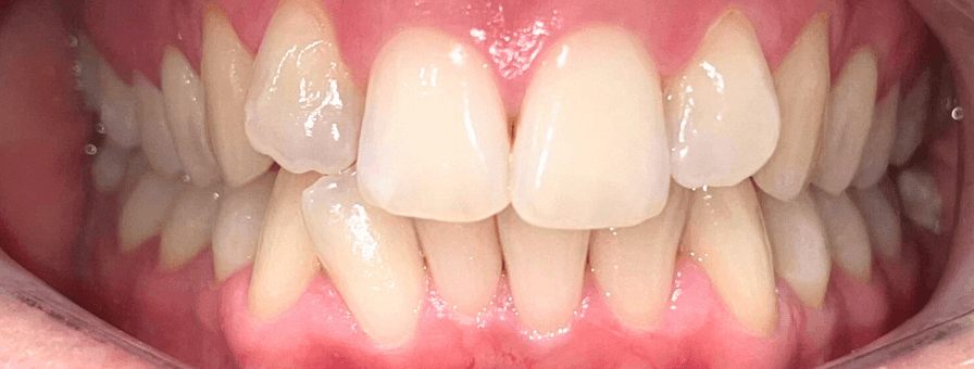 Înainte de tratamentul ortodontic