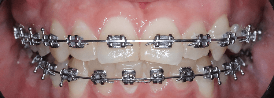 După tratamentul ortodontic