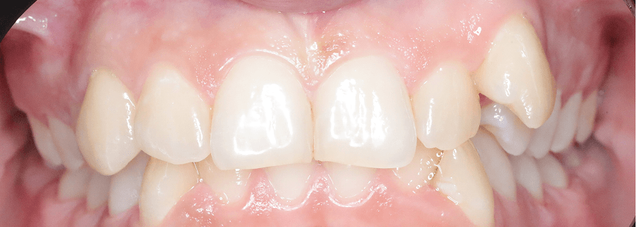 Înainte de tratamentul ortodontic