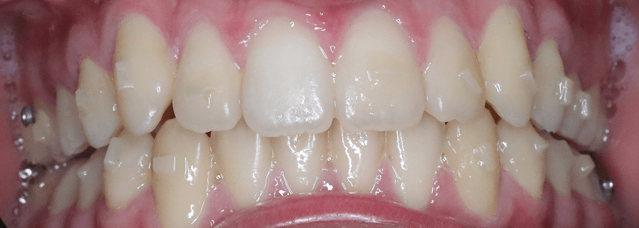 După tratamentul ortodontic