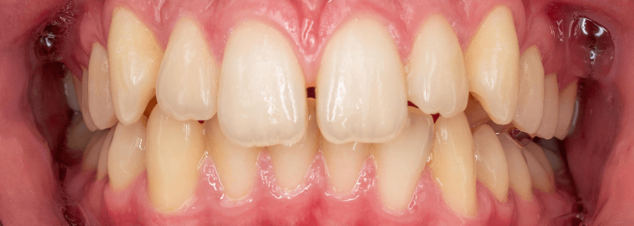 Înainte de tratamentul ortodontic