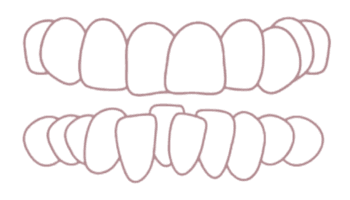 Inghesuire dentara