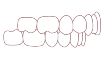 Overbite usor