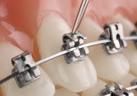 Aparat dentar metalic autoligaturant