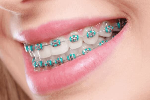 aparat dentar metalic