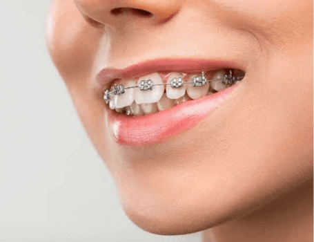 Servicii ortodontie Cluj - aparate dentare moderne