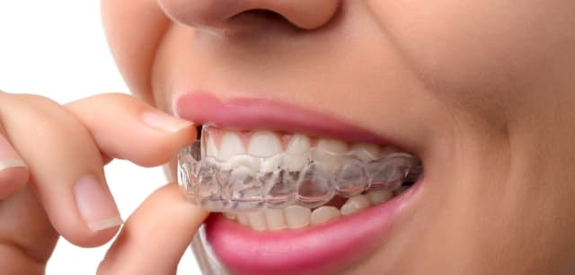 Aligner dentar transparent