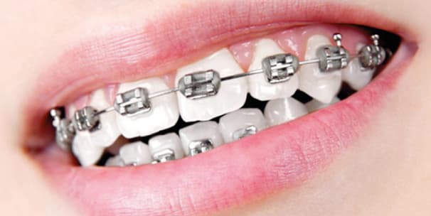 Aparat dentar metalic clasic