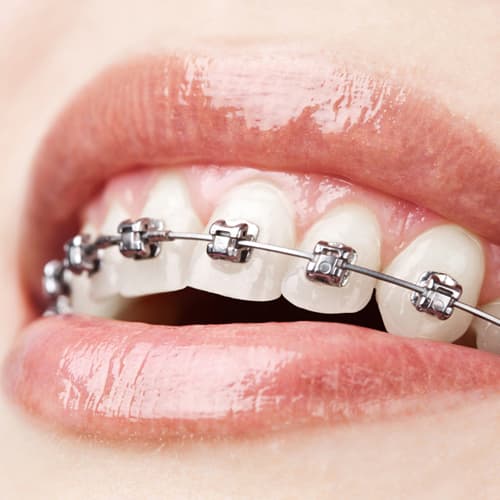 Aparat dentar Damon