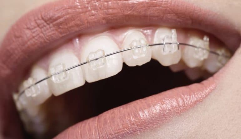 Aparat dentar safir / fizionomic