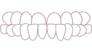 Underbite usor