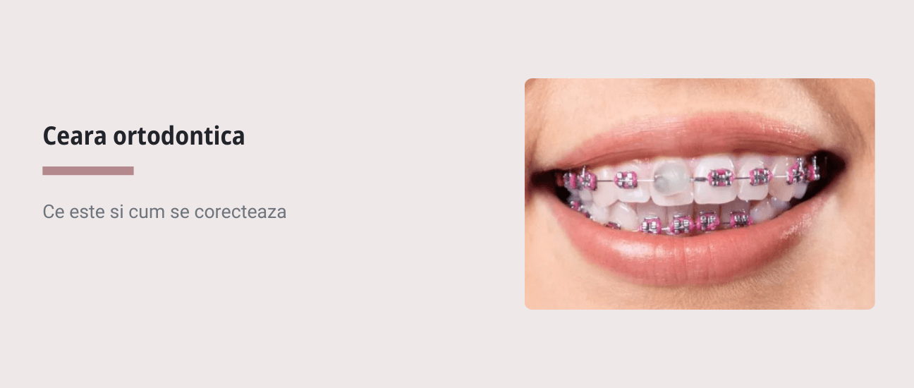 Ceara ortodontica - Articol stomatologie