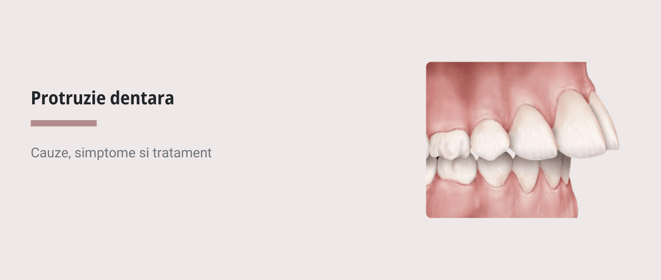 Protruzie dentara: cauze, simptome si tratament - Articol stomatologie