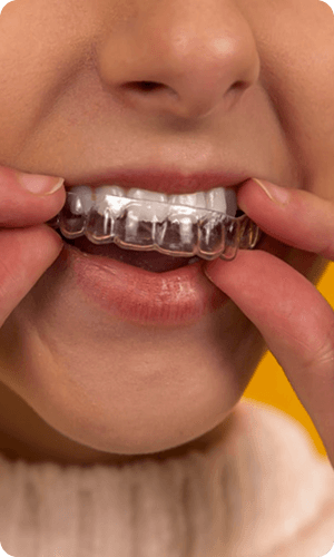 Aligner dentar Spark - aparate dentare transparente Cluj