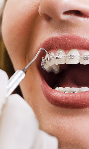 Aparat dentar clasic - tratament ortodontic Cluj-Napoca