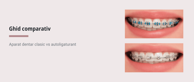 Aparat dentar clasic vs autoligaturant - ghid comparativ
