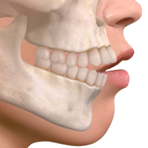 Chirurgia ortognată - corectarea deformărilor maxilarelor
