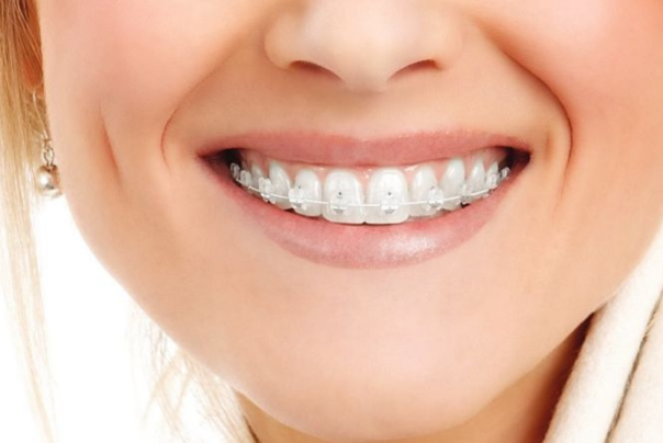 aparat dentar safir