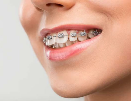 Ortodontie cluj, aparate dentare