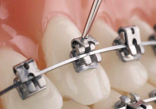 aparat dentar autoligaturant